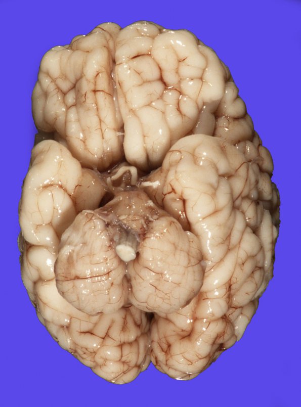 1A2 Patau Syndrome (Case 1) 5