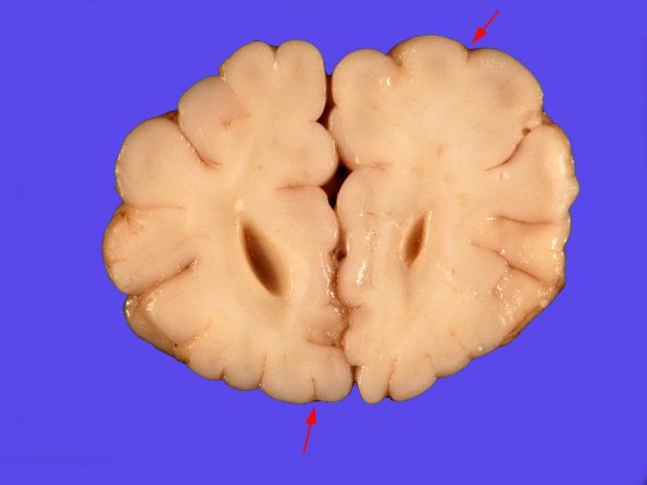 1A4 Patau Syndrome (Case 1) 11