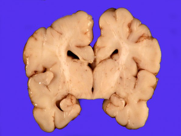 1A5 Patau Syndrome (Case 1) 12