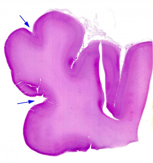 1B1 Patau Syndrome (Case 1) N1 H&E whole mount 2