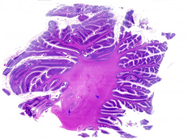 1B2 Patau Syndrome (Case 1) N9 H&E whole mount