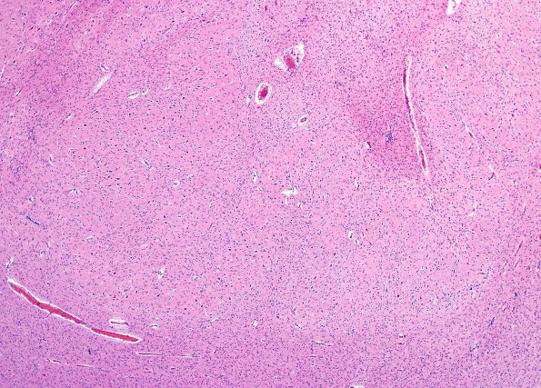 1B3 Patau Syndrome (Case 1) N9 H&E 3