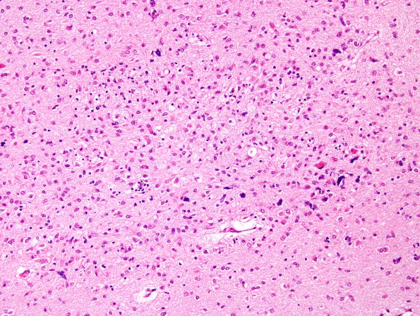 1B4 Patau Syndrome (Case 1) N11 H&E 1