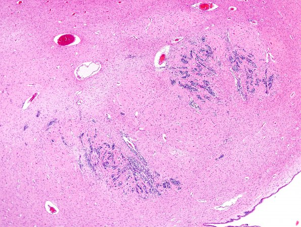 1B5 Patau Syndrome, dentate nucleus (Case 1) N9 H&E 2