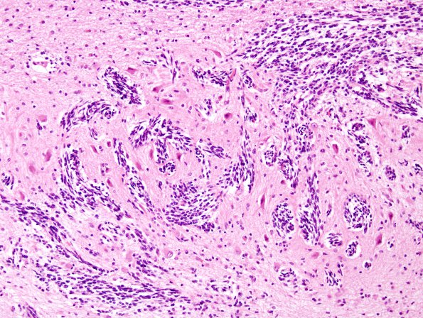 1B6 Patau Syndrome, dentate nucleus (Case 1) N9 H&E 1