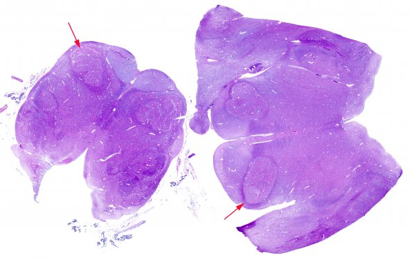 1C1 Patau Syndrome (Case 1) ION medulla H&E whole mount