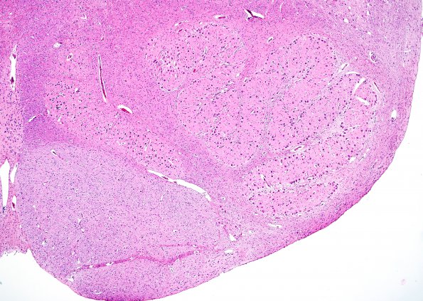 1C2 Patau Syndrome (Case 1) ION medulla H&E