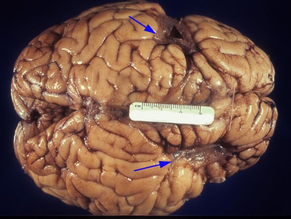 10A1 Porencephaly PMG at edge (Case 10) - Copy