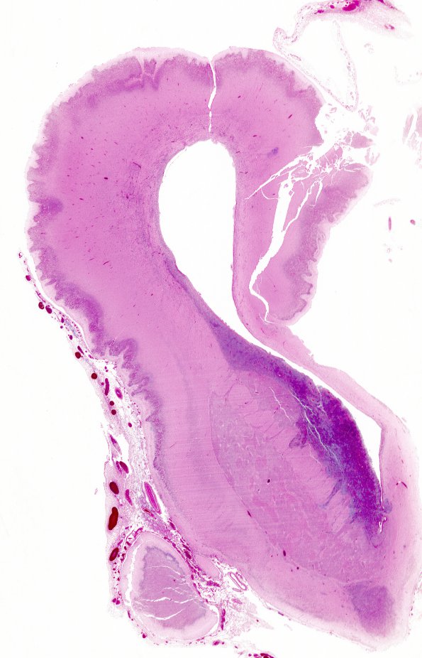 12A1 Polymicrogyria, developing (Case 12)  whole mount