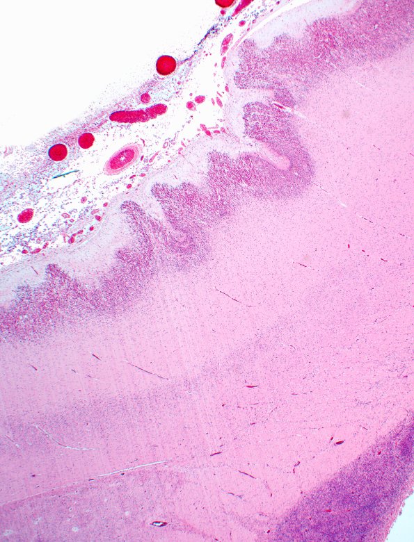 12A2 PMG New (Case 12) H&E 2X A