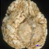 13A Polymicrogyria (Case 13)