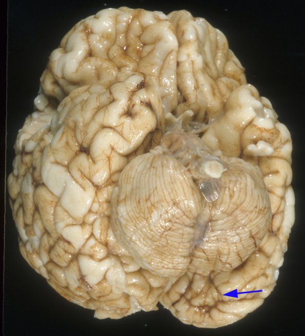 13A Polymicrogyria (Case 13)