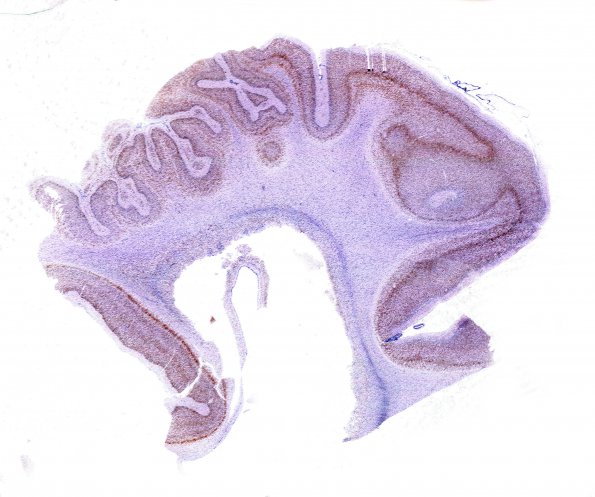 13B2 Polymicrogyria (Case 13) NeuN 2