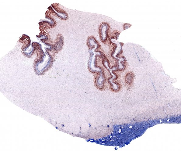 14B Polymicrogyria (Case 16) NeuN whole mount