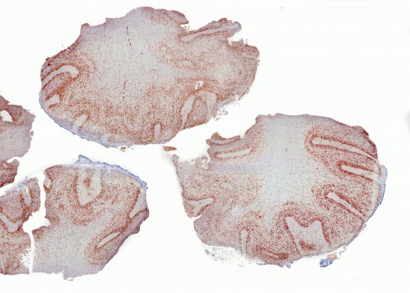 18 Heterotopia, glioneuronal, intravent, & PMG (Case 18) NeuN whole mount 1AA