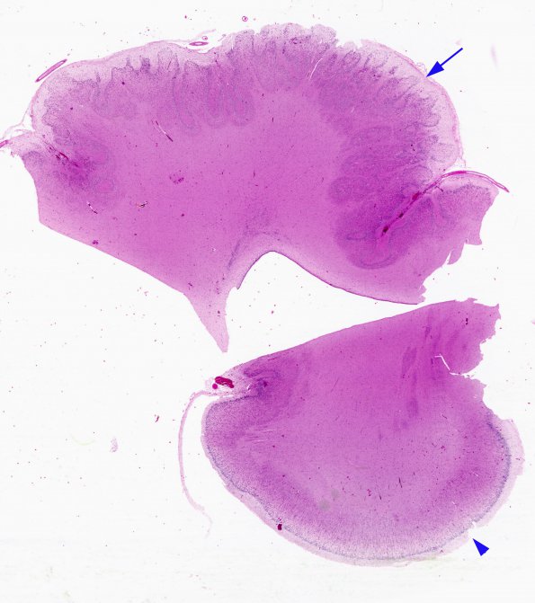 1B1 Polymicrogyria (Case 1) H&E whole mount 2