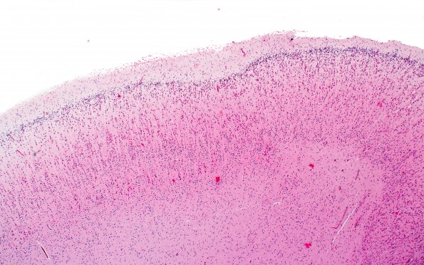 1B2 Polymicrogyria (Case 1) 4X Control area H&E 4X 1A