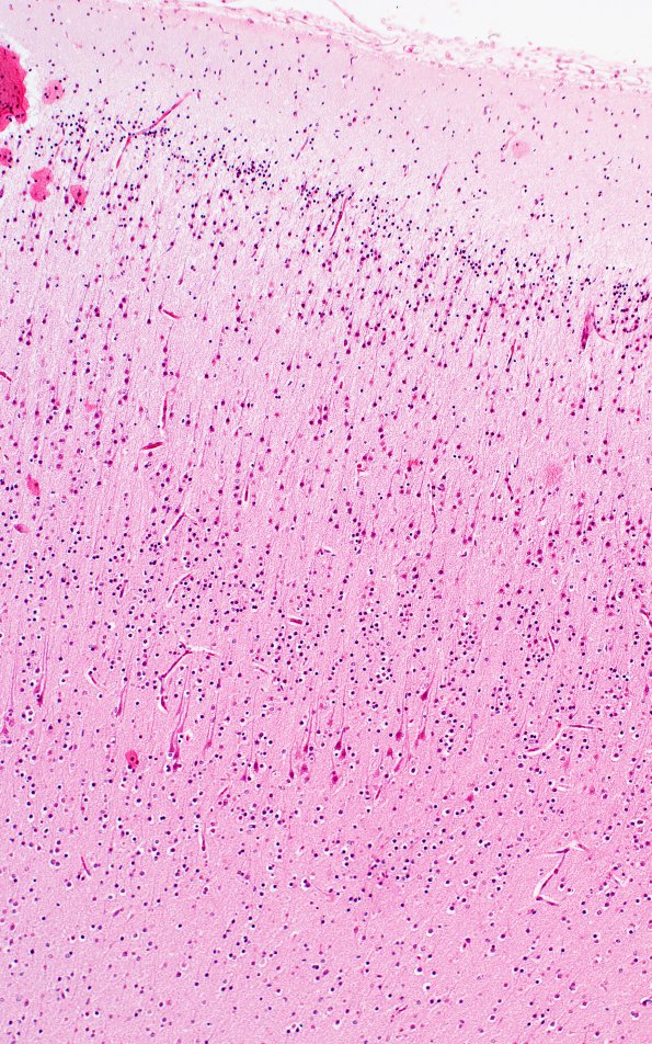 1B3 Polymicrogyria (Case 1) 4X Control area H&E 10X 1