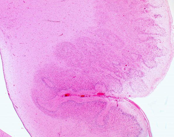 1B5 Polymicrogyria (Case 1) 4X PMG area H&E 2X 2A