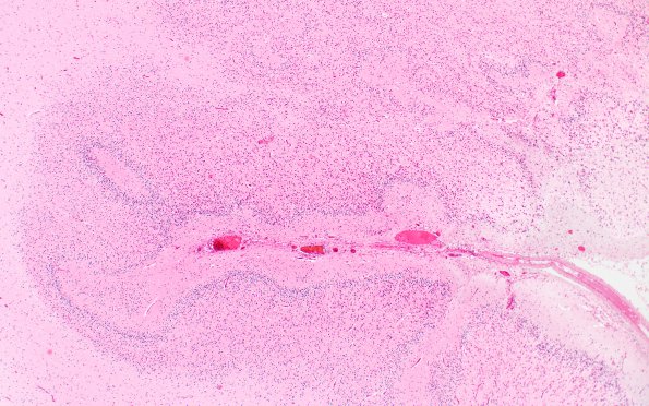 1B6 Polymicrogyria (Case 1) 4X PMG area H&E 4X 3