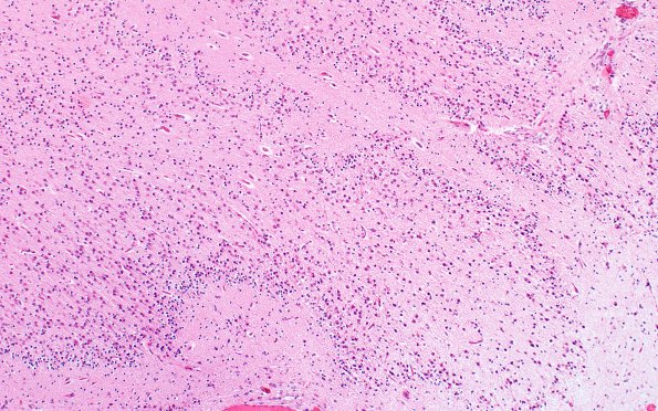 1B7 Polymicrogyria (Case 1) 4X PMG area H&E 10 2