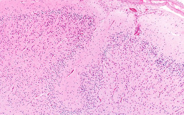 1B8 Polymicrogyria (Case 1) 4X PMG area H&E 10X 1