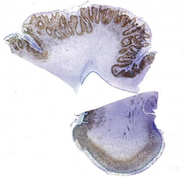 1C1 Polymicrogyria (Case 1) 1