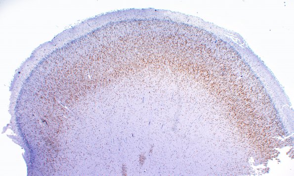 1C2 Polymicrogyria (Case 1) 2X Control area