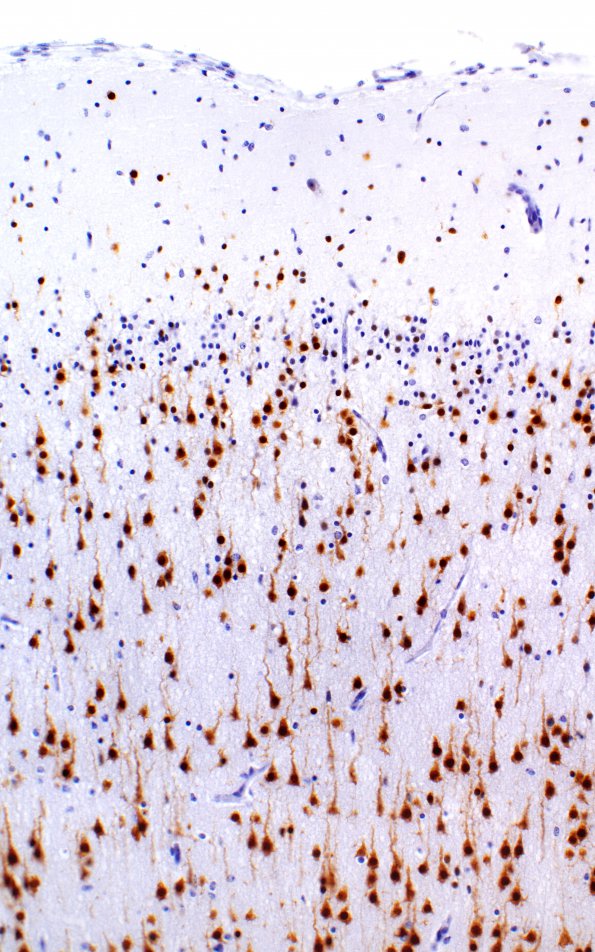 1C3 Polymicrogyria (Case 1) 20X Control area