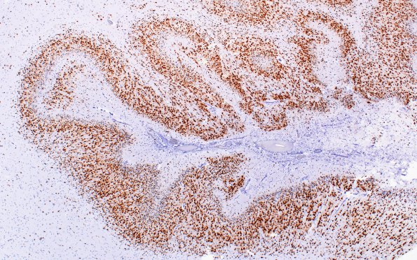 1C5 Polymicrogyria (Case 1) 20X PMG area (2)