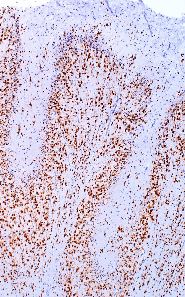 1C6 Polymicrogyria (Case 1) 20X PMG area