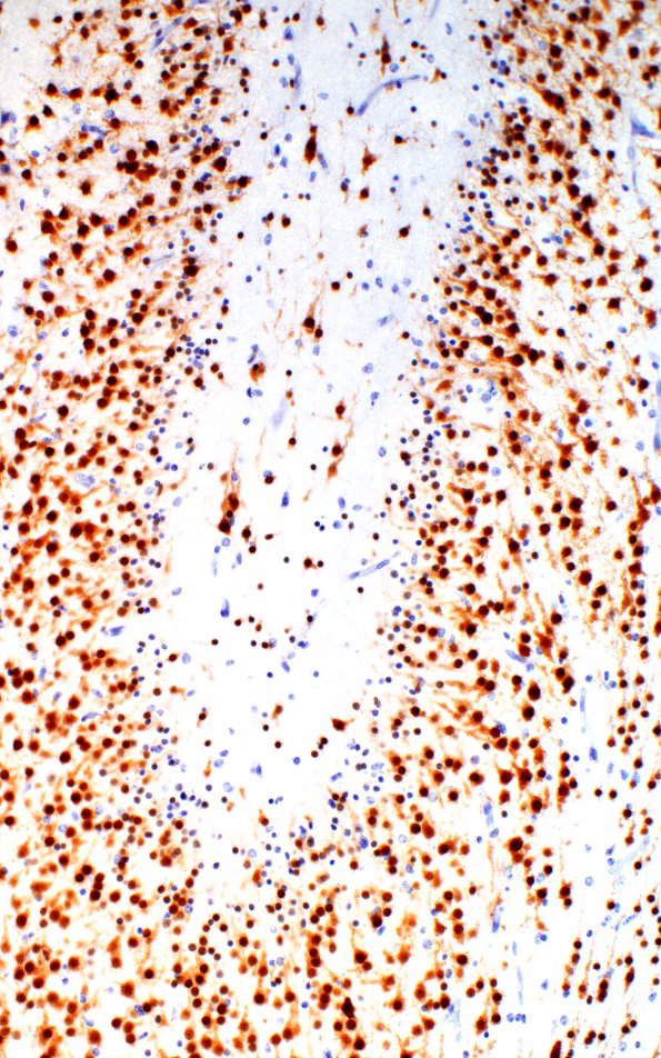 1C7 Polymicrogyria (Case 1) 20X PMG area 2