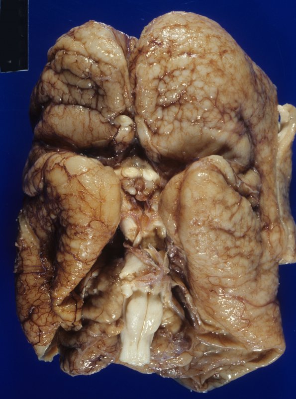 2A1 Polymicrogyria and hydrocephalus (Case 2, 2 yo) 1