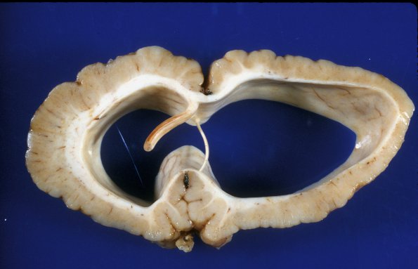 2A3 Polymicrogyria (Case 2, 2 yo) C