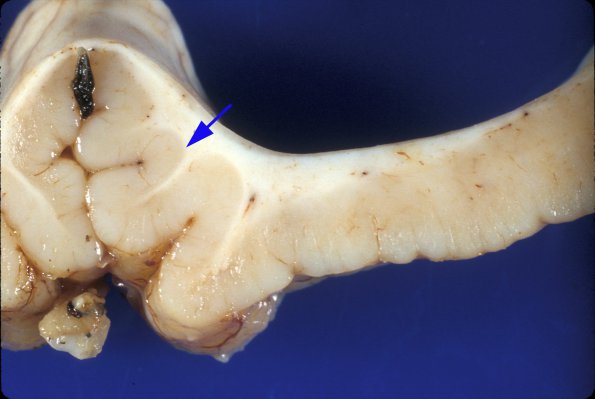 2A4 Polymicrogyria (Case 2, 2 yo) F