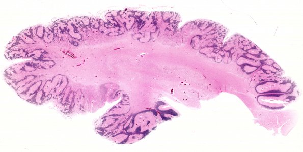 2B Polymicrogyria (Case 2, 2 yo) D