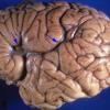 3A1 Polymicrogyria (Case 3) & Heterotopia gross 2