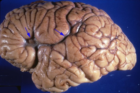 3A1 Polymicrogyria (Case 3) & Heterotopia gross 2