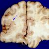 3A2 Polymicrogyria, focal (Case 3) original form gross 6A