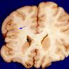 3A3 Polymicrogyria, focal (Case 3) original form gross 5A