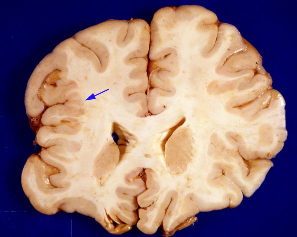 3A3 Polymicrogyria, focal (Case 3) original form gross 5A