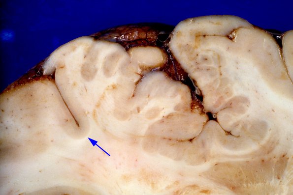 3A6 Polymicrogyria, focal (Case 3) original form gross 2A