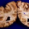 3A7 Polymicrogyria, focal (Case 3) 7