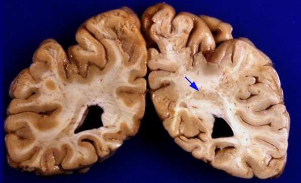 3A7 Polymicrogyria, focal (Case 3) 7