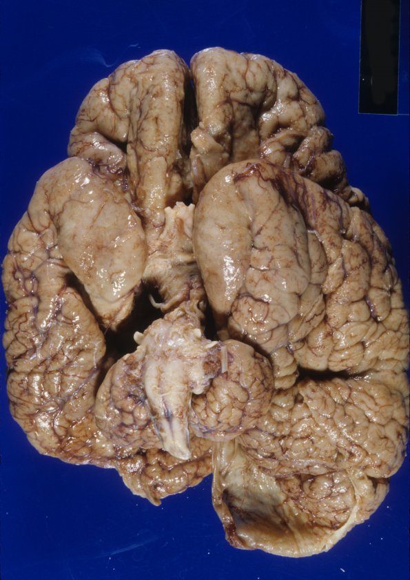 4A1 Polymicrogyria and hydrocephalus (Case 4) 18