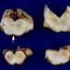 4A10 Polymicrogyria and hydrocephalus (Case 4) 14