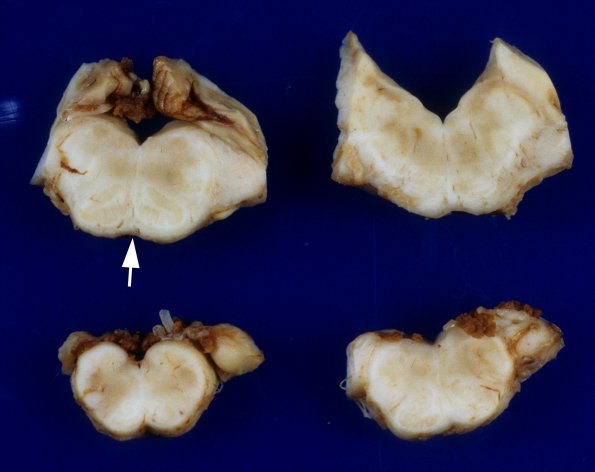 4A10 Polymicrogyria and hydrocephalus (Case 4) 14