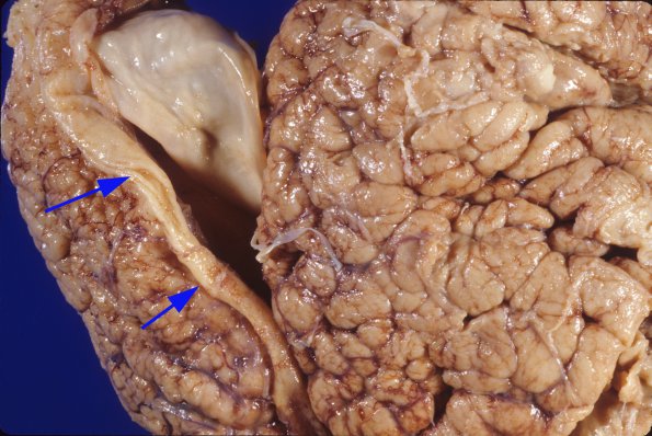 4A2 Polymicrogyria and hydrocephalus (Case 4) 1