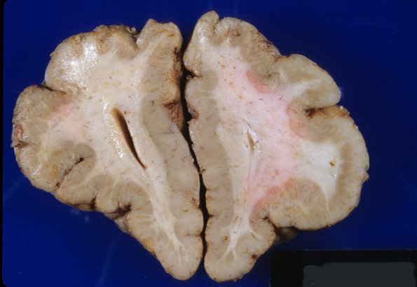 4A4 Polymicrogyria and hydrocephalus (Case 4) 7