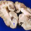 4A6 Polymicrogyria and hydrocephalus (Case 4) 9A